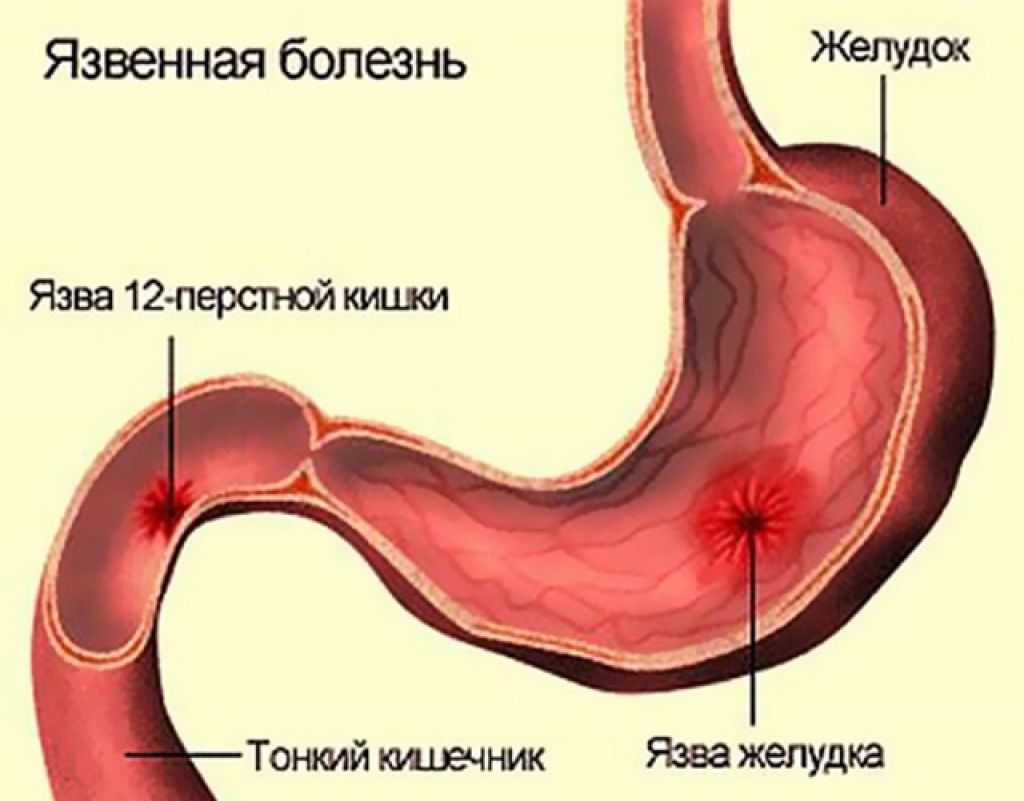 Клиническая картина язвенной болезни желудка и двенадцатиперстной кишки