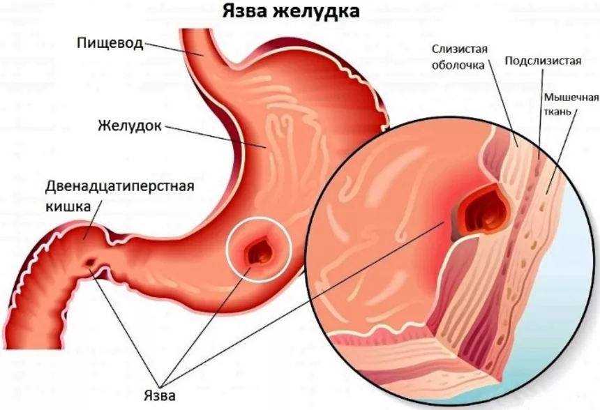 Язва прямой и ободочной кишки: причины, симптомы и лечение