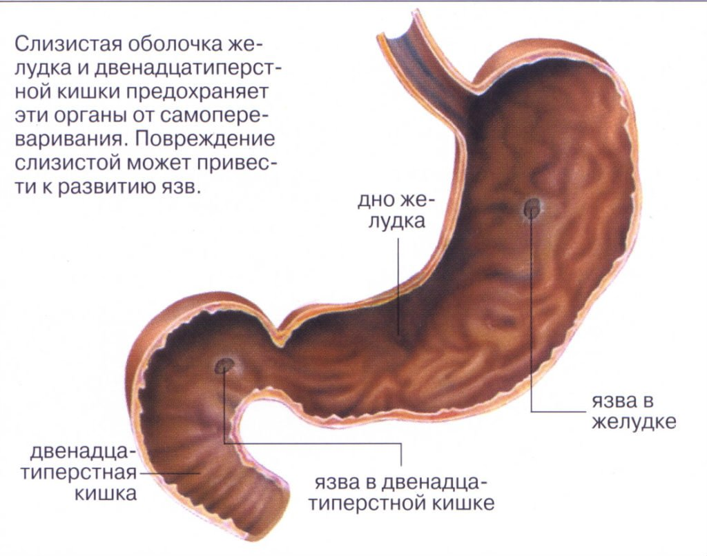 Клиническая картина язвенной болезни желудка и двенадцатиперстной кишки