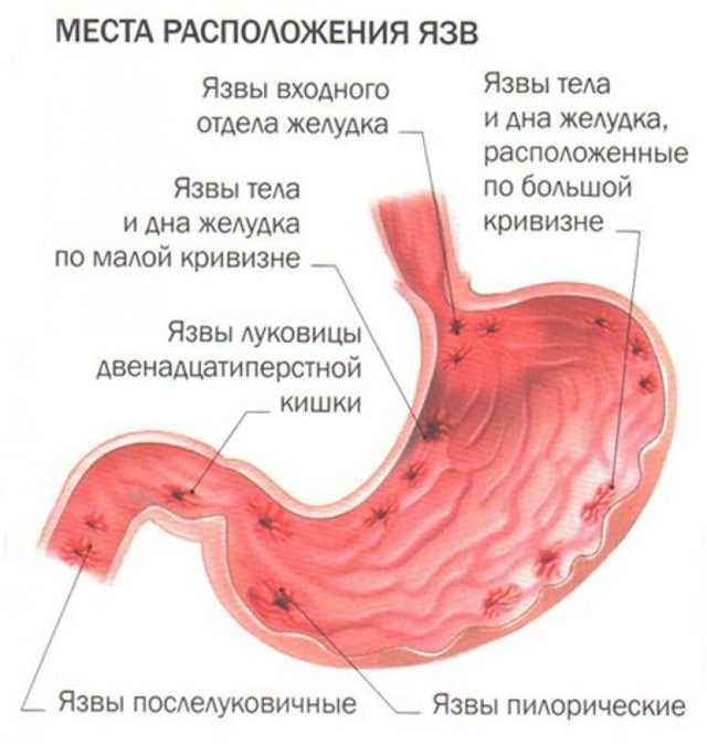 Что такое язва желудка - симптомы, причны и лечение язвы желудка | ЛДЦ Кутузовский