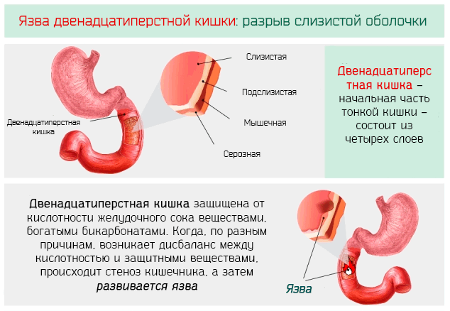 Язва двенадцатиперстной кишки ᐈ Диагностика и лечение | Университетская клиника г. Фрайбурга