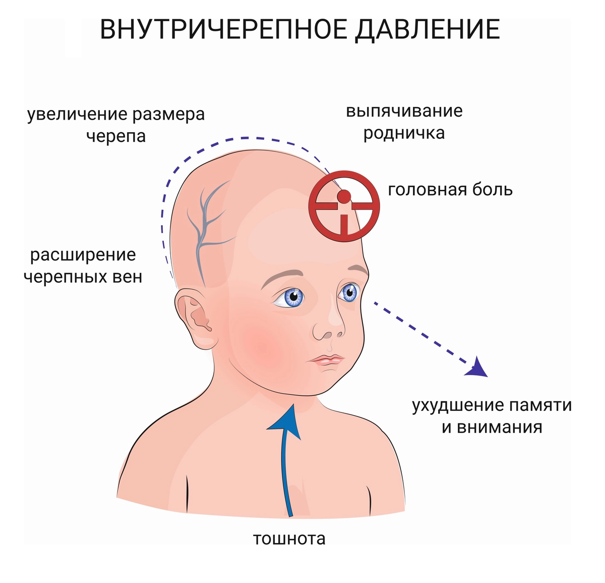 Внутричерепное давление у детей – чем оно опасно, как его заподозрить и  вылечить | О детском здоровье: с врачебного на родительский | Дзен