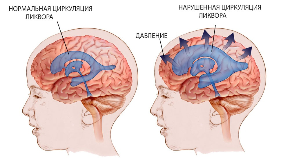 Причины, измерение и лечение внутричерепного давления