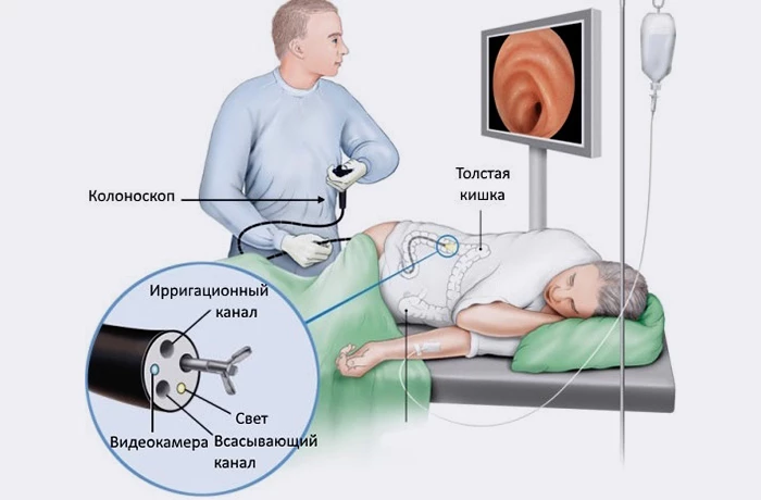 Колоноскопия - это процедура, позволяющая врачу визуально осмотреть всю слизистую оболочку толстой кишки и прямой кишки с помощью колоноскопа (длинная гибкая трубка толщиной с палец).