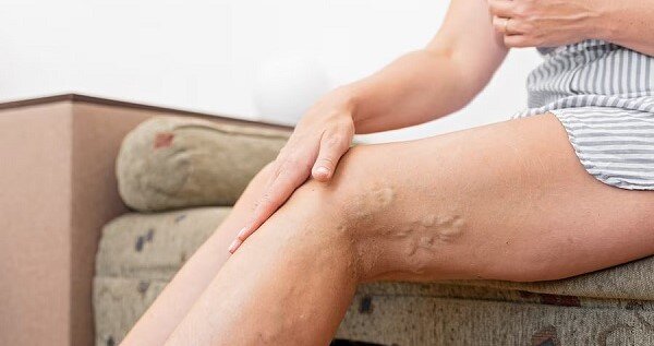 Варикоз считается не только эстетическим дефектом, но и опасным заболеванием