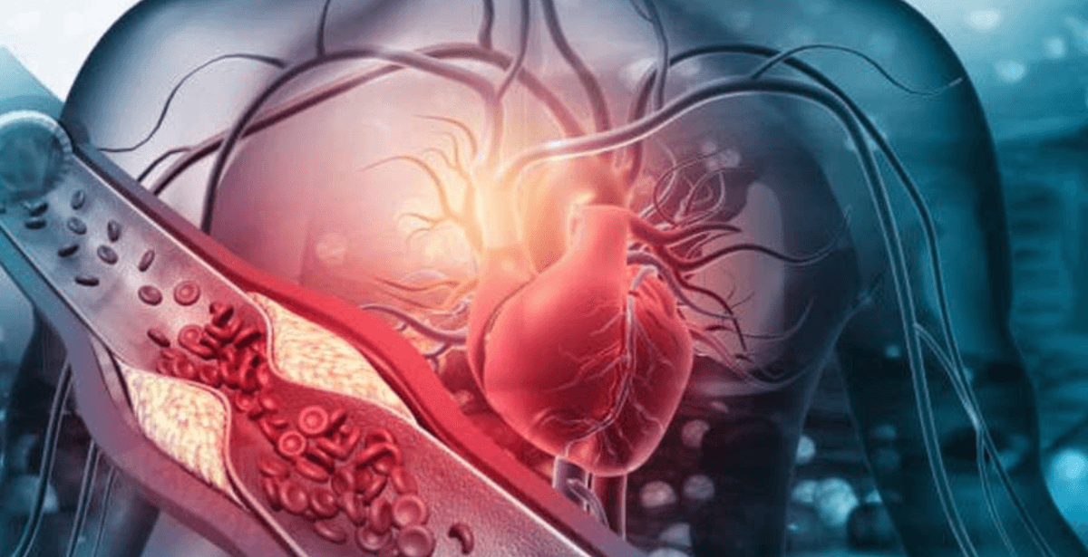    Отрыв тромба часто приводит к летальному исходу