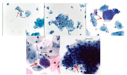 Рисунок 1. Бациллы Lactobacilli spp. в составе нормальной флоры (красная стрелка, вверху слева и вверху посередине). Пример клетки-подсказки (красная стрелка): промежуточная сквамозная клетка, покрытая виноградоподобными короткими коккобациллами (Gardnerella vaginalis) со смещением в сторону нормальной флоры (вверху справа). То, что на первый взгляд кажется клеткой-подсказкой (красная стрелка), при ближайшем рассмотрении оказывается промежуточной сквамозной клеткой, окруженной нормальной флорой (внизу слева). Фолликулярный цервицит, вызванный хламидийной инфекцией (внизу справа). Обратите внимание на лимфогистиоцитарные агрегаты с полиморфными лимфоцитами и гистиоцитами (красная стрелка). 