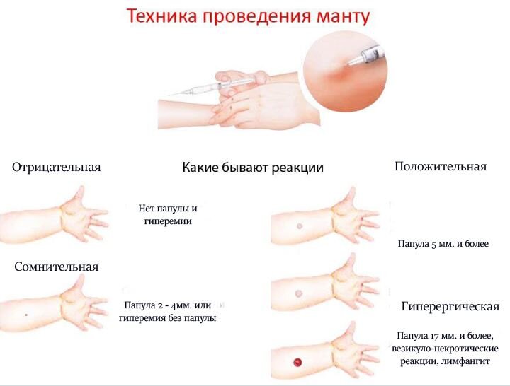 Диагностика туберкулеза