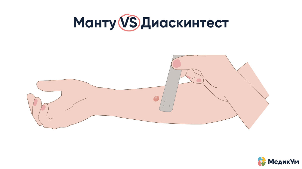 МАНТУ, ДИАСКИНТЕСТ, Т-СПОТ – ЧТО ЛУЧШЕ?