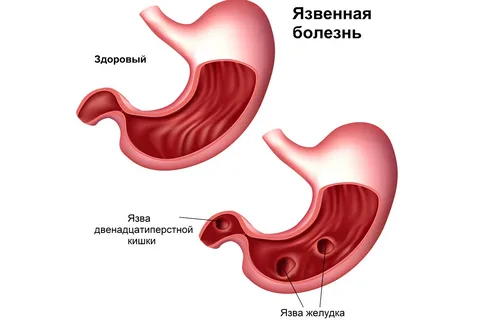 Госпитализация при язве желудка