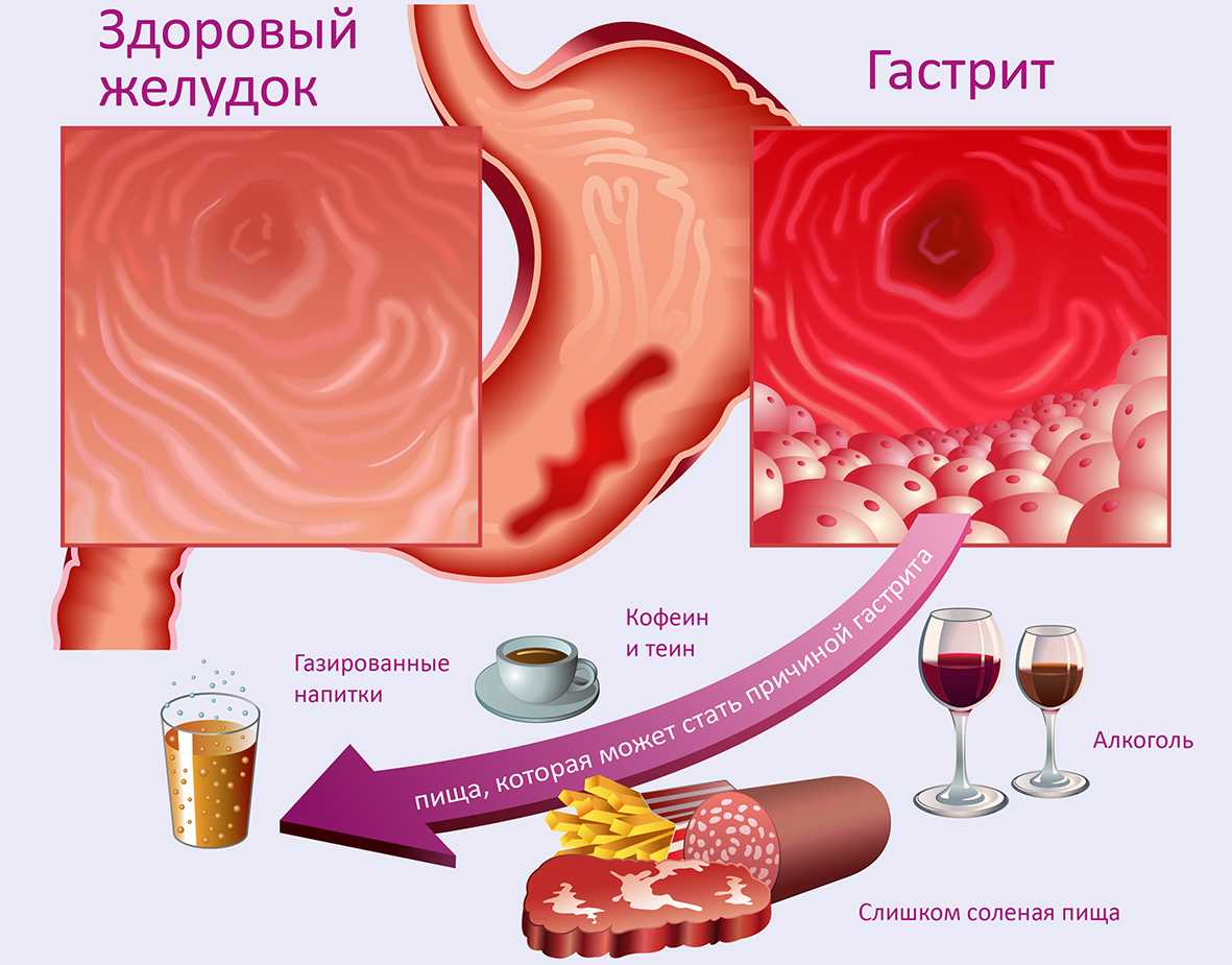 Язва желудка, симптомы язвы - Клиника Здоровье г. Екатеринбург