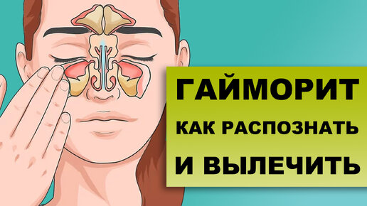 ГАЙМОРИТ. СИНУСИТЫ. Как диагностировать и лечить