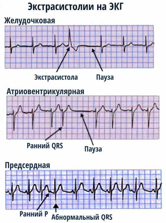 Как быстро снять экстрасистолию