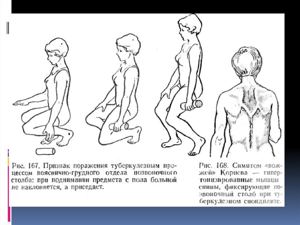 симптом вожжей Корнева