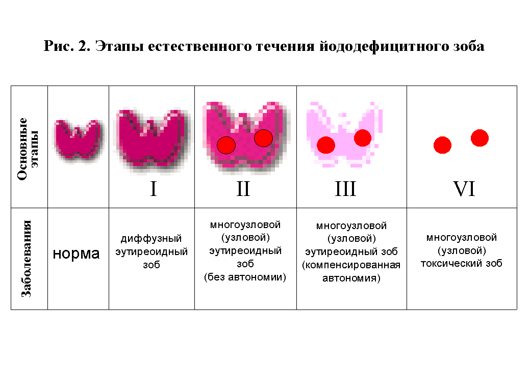 Диффузные и диффузно-узловые токсические формы зоба