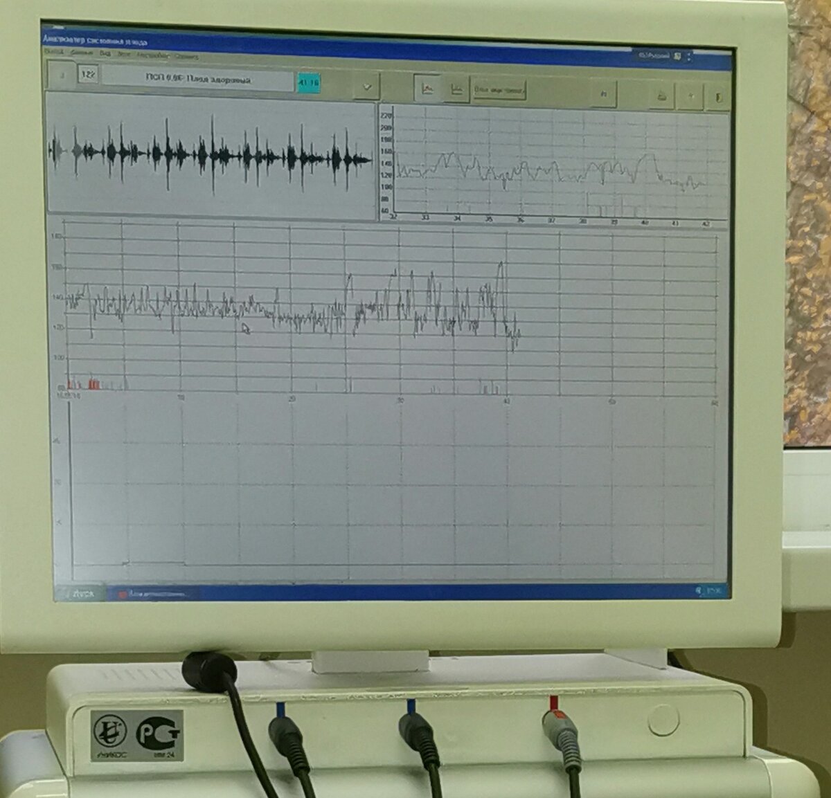КТГ еще в консультации...