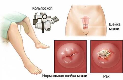 РАК ШЕЙКИ МАТКИ, СИМПТОМЫ,ЛЕЧЕНИЕ.