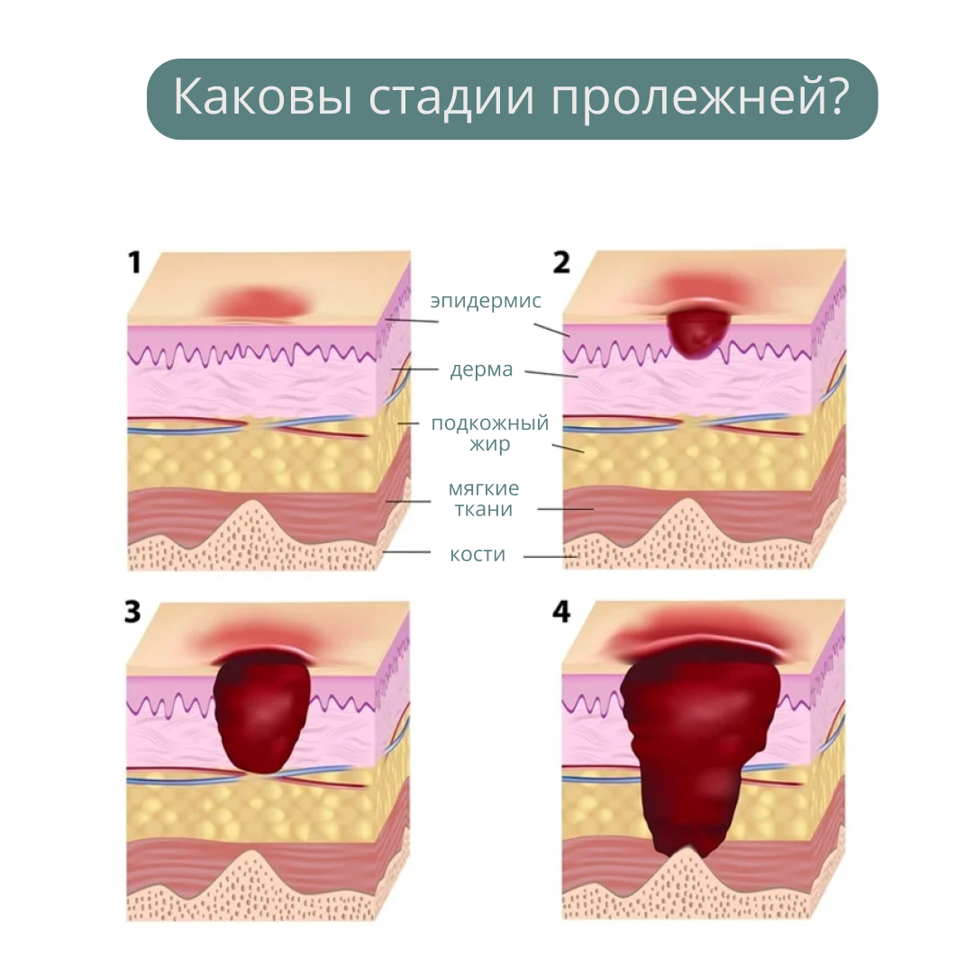 Размер пролежня