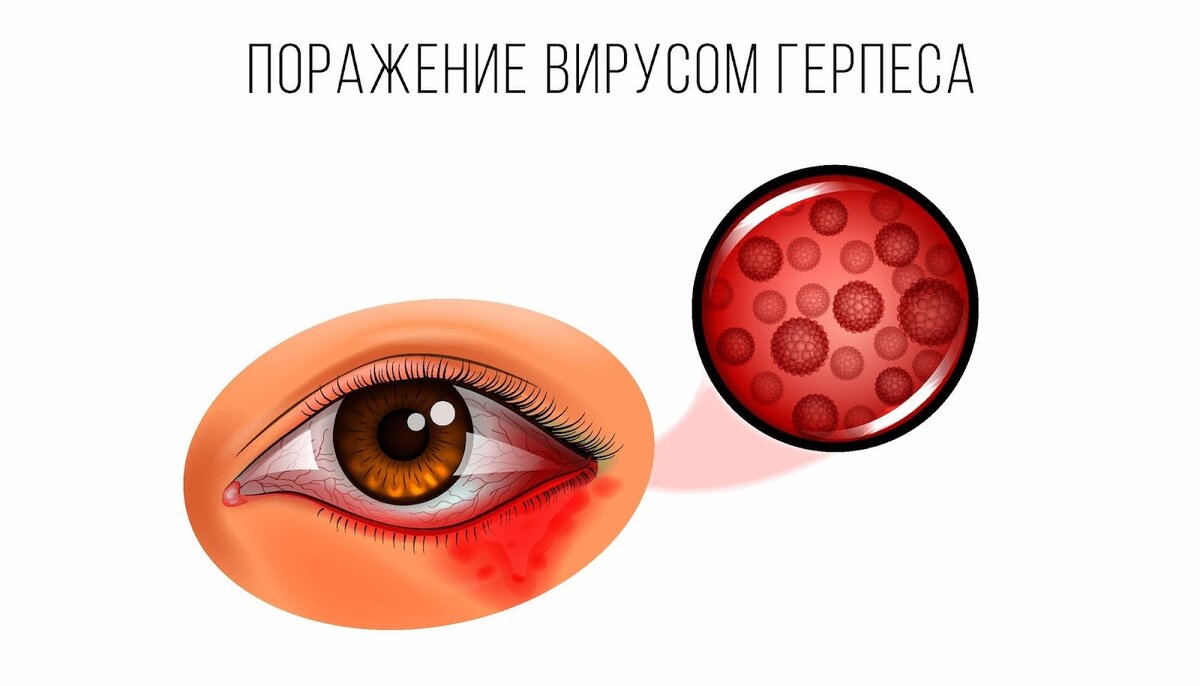 Как выглядит герпес под глазом
