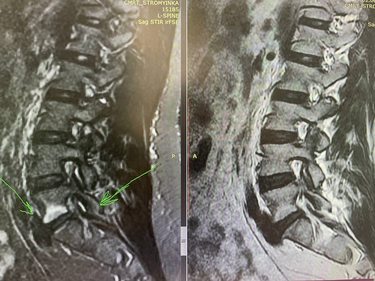 Спондилит на МРТ