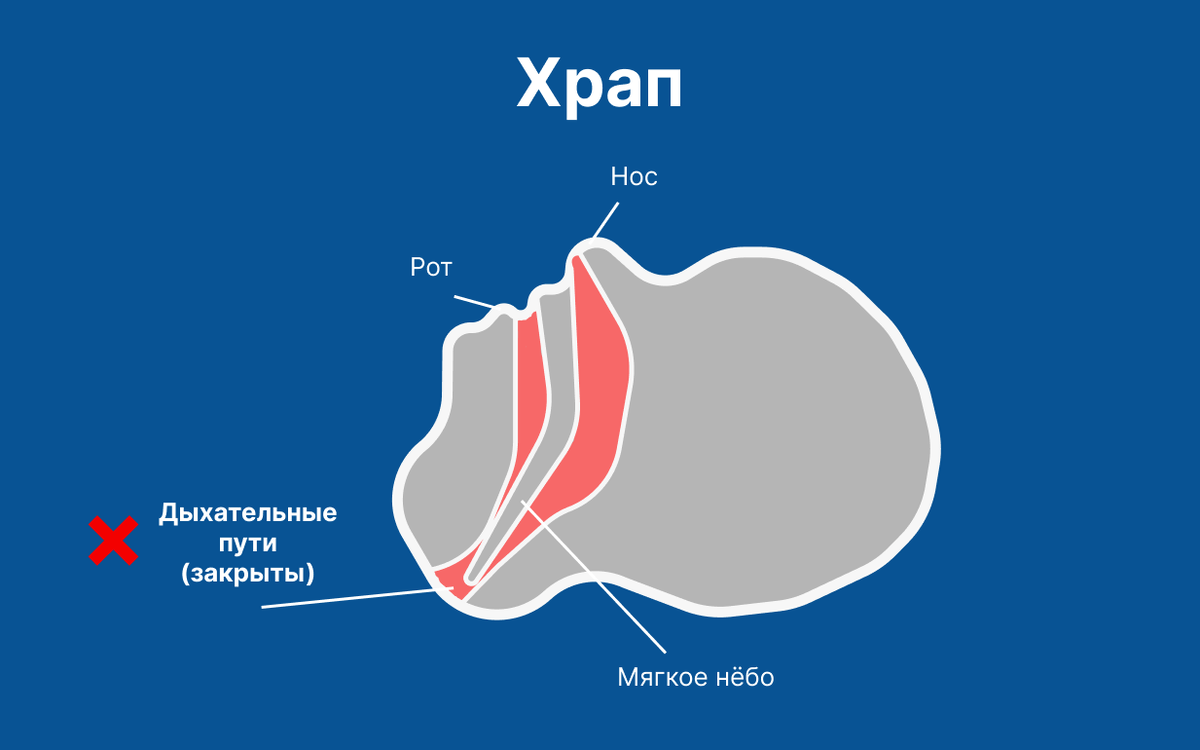 Виды храпа