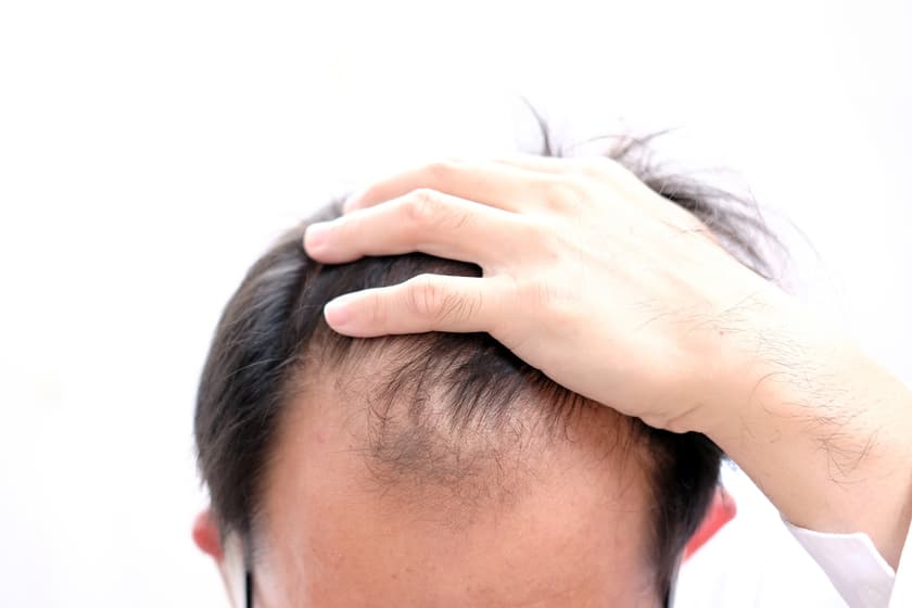 Гель из кератиновых шариков микроразмеров способствовал росту волос у мышей. Depositphotos