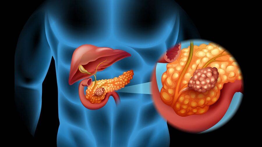 В данной статье рассмотрены современные аспекты этиологии, клиники, диагностики синдрома Золлингера-Эллисона и принципы лечения данного состояния. Представлены методики диагностического поиска у пациентов с часто рецидивирующими и резистентными к терапии эрозивно-язвенными поражениями верхних отделов желудочно-кишечного тракта.