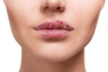 герпес  слизистой мягкой ткани фотография взята из открытых источников Яндекс картинки 