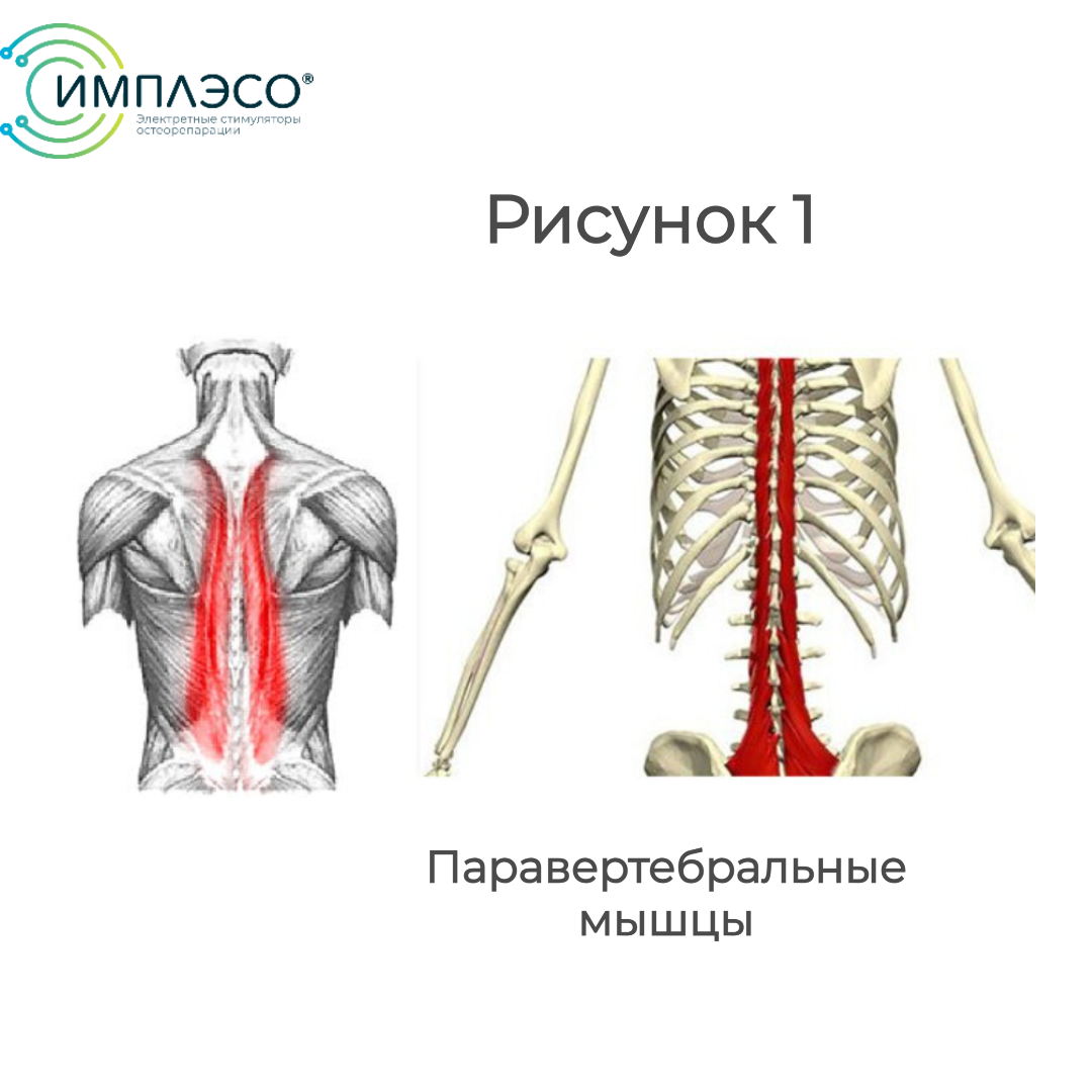 Тренируем паравертебральные мышцы | ИМПЛЭСО® - лечение артроза | Дзен