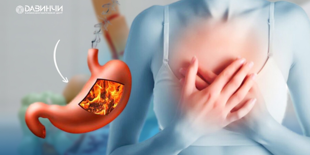 Прощай, изжога: определяем и контролируем пищевые триггеры при ГЭРБ