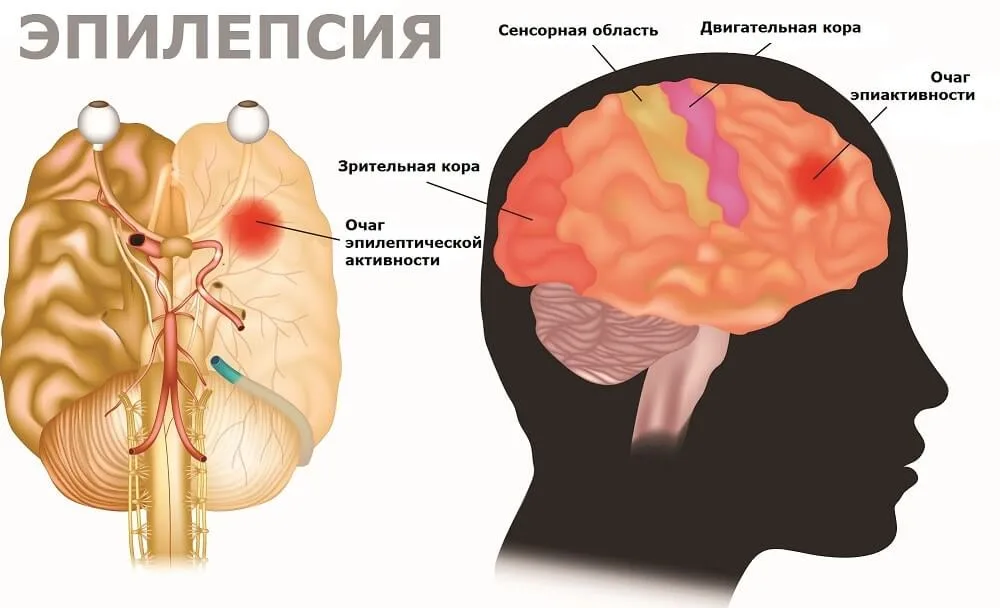 Припадок головного мозга. Эпилепсия мозг. Очаги эпилепсии в головном мозге. Мозг при аутизме.