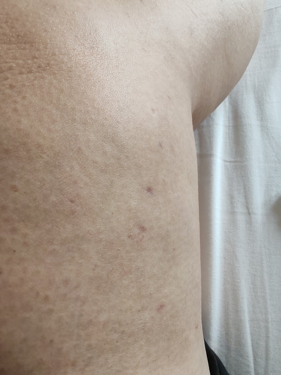 Ещё три месяца назад нога ныла на погоду, отекала, а теперь готовится к лету. 