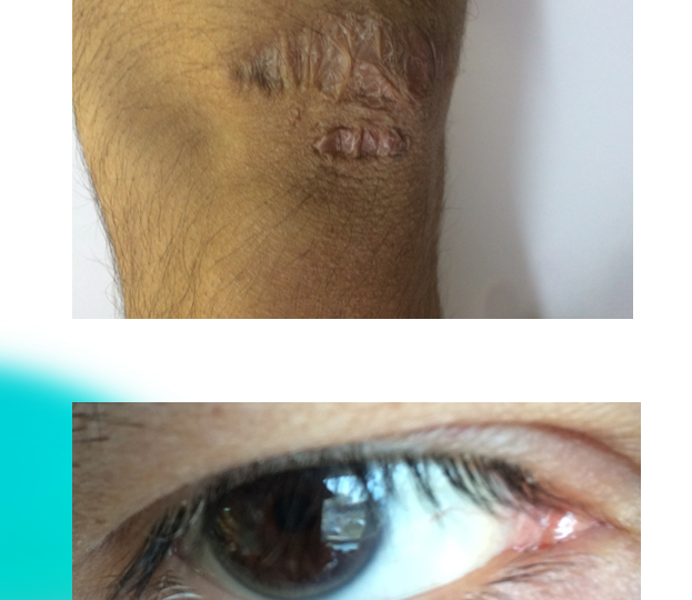 Когда в повышенном холестерине виновата генетика, а не питание?