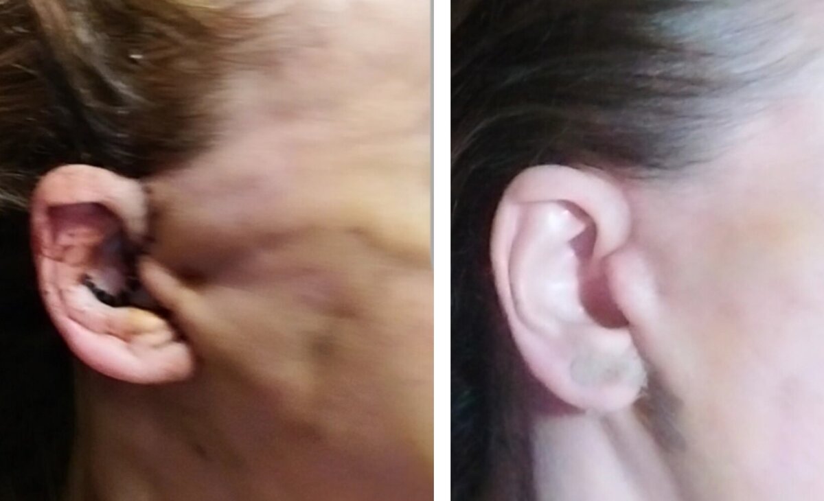 ухо после операции и через 3 недели после