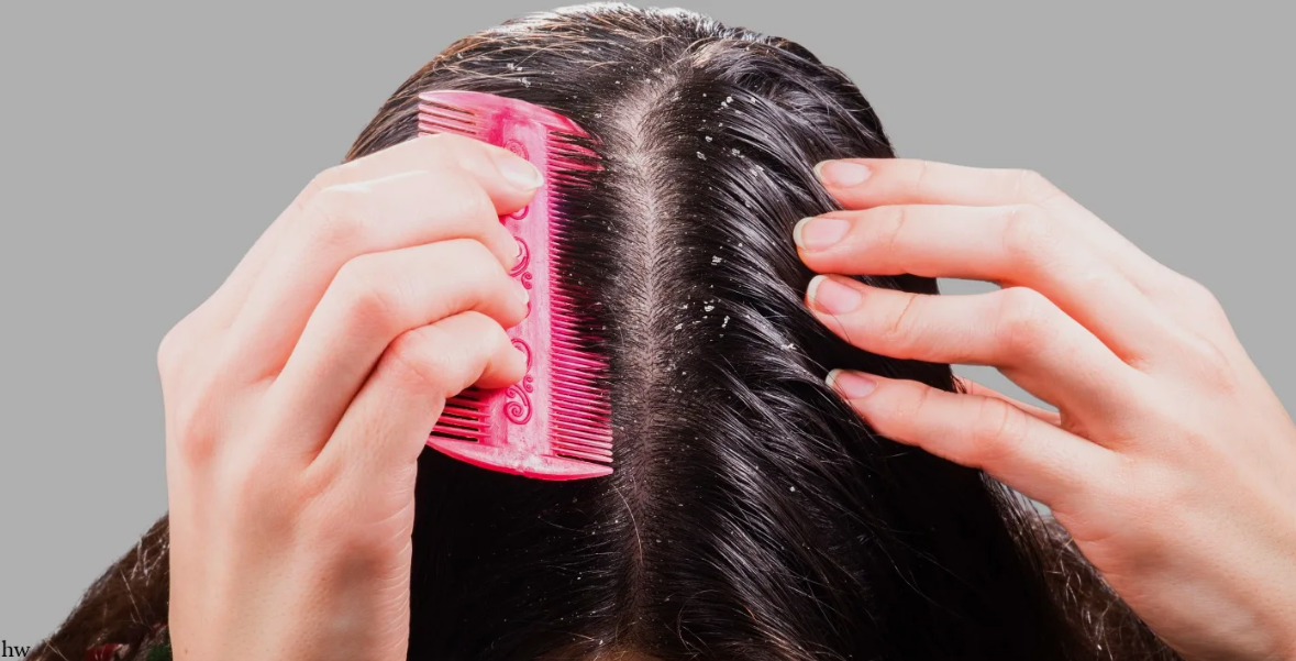 Как вылечить себорею