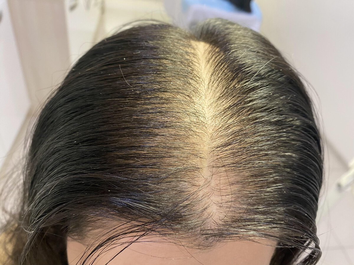 зима выпадают волосы. редкие волосы. волосы зимой. зима выпадают волосы. зима выпадают волосы.