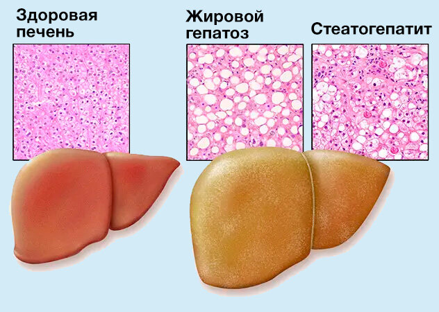 Разница между здоровой печенью и печенью с жировым гепатозом
