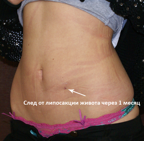 Липосакция: через 1 месяц после операции