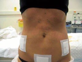 Липосакция: сразу после операции