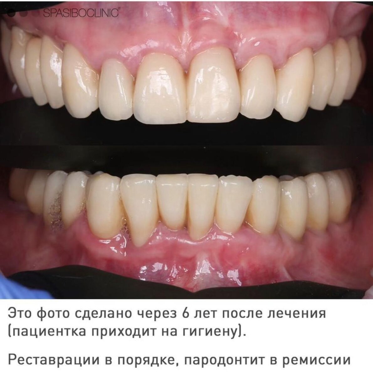 СОХРАНЕНИЕ ЗУБОВ | Спасибо.Клиник | Дзен