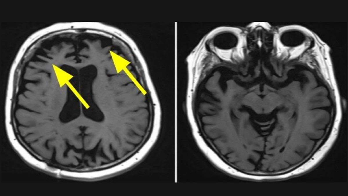 Атрофия вещества головного мозга в лобных областях, истончение извилин. Источник: https://sdelatmrt.spb.ru/