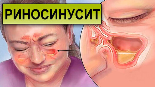 РИНОСИНУСИТ. Чем опасно заболевание?