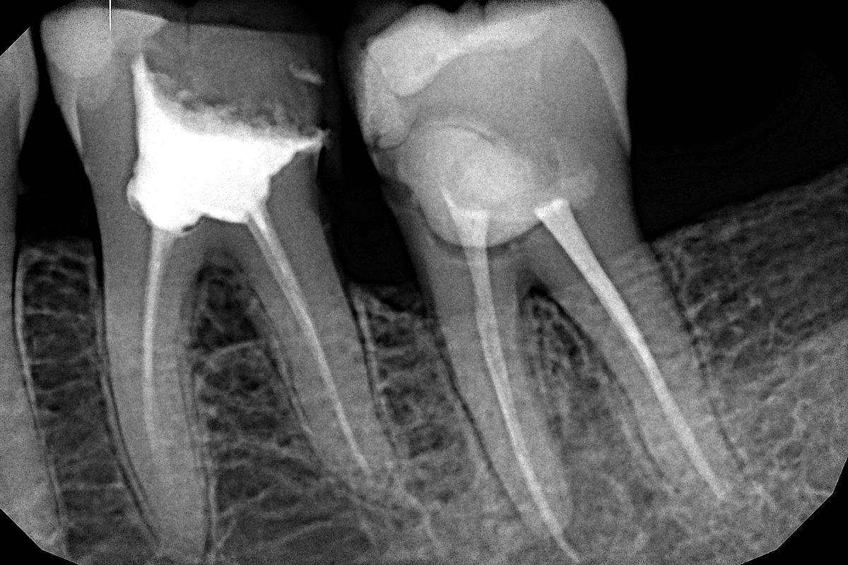 рентген зуба