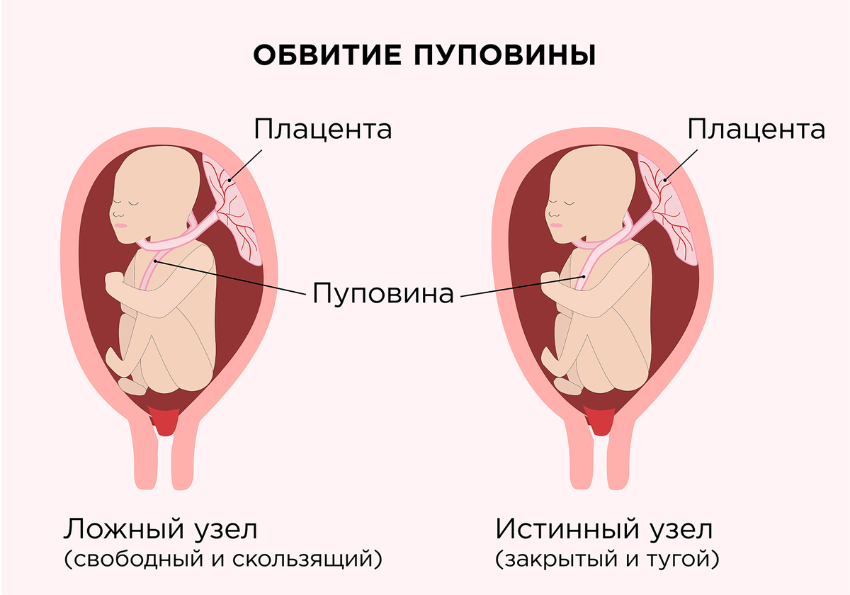 Что значит ребенок по задней стенке