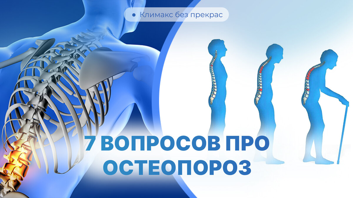 7 вопросов про остеопороз