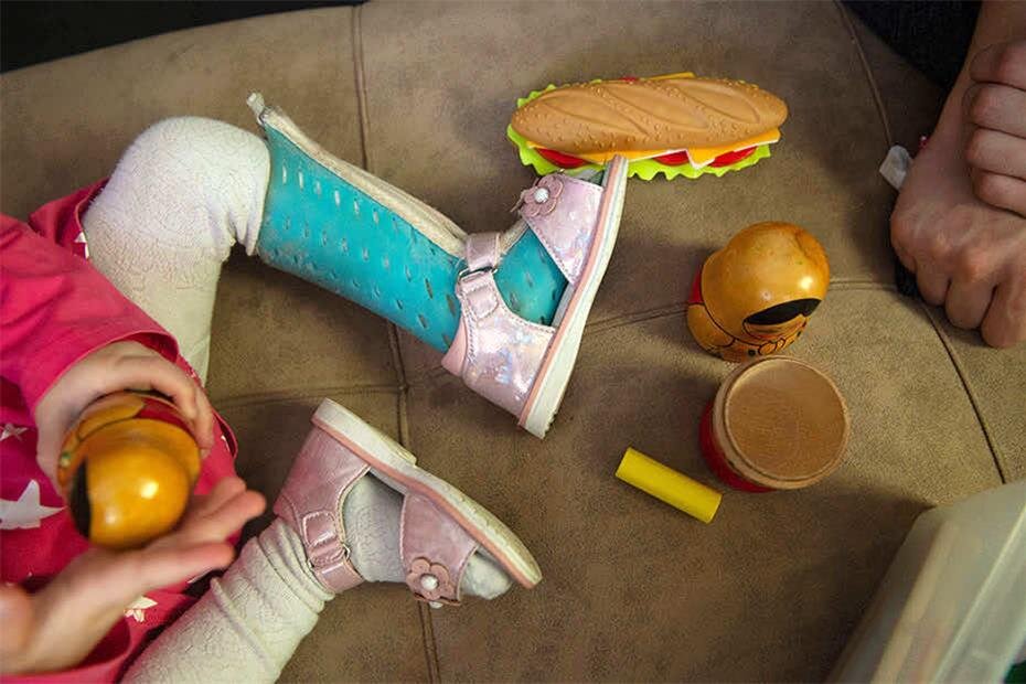 Накануне операции на ушке Сима сломала ногу. На месте перелома ...