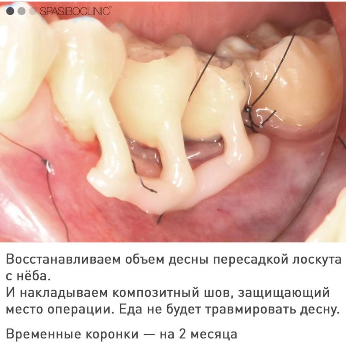 ОШИБКИ ПРОТЕЗИРОВАНИЯ | Спасибо.Клиник | Дзен