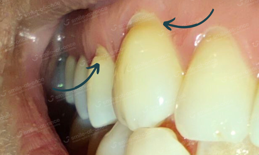 Клиновидный дефект зубов. Лечение клиновидного дефекта