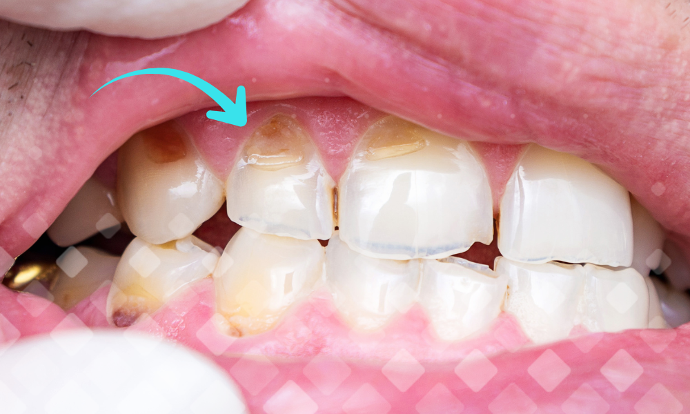 Один из характерных признаков клиновидного дефекта – появление желтоватых углублений у основания зубов. 