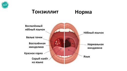 Острый тонзиллит: симптомы и лечение. Как и чем лечить тонзиллит. Как выглядит тонзиллит